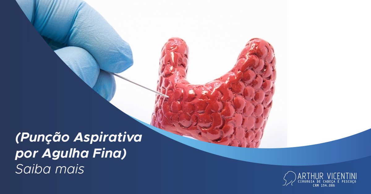 Paaf PAAF (Punção Aspirativa Por Agulha Fina): Saiba Mais - Dr. Arthur ...