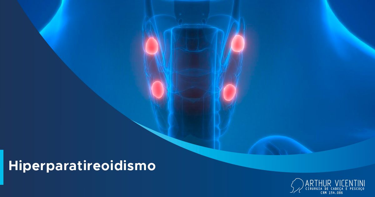 Hiperparatireoidismo - Dr. Arthur Vicentini CRM-SP 154086