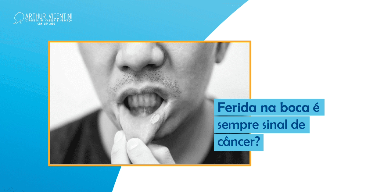 Ferida Na Boca é Sempre Sinal De Câncer? - Dr. Arthur Vicentini CRM-SP