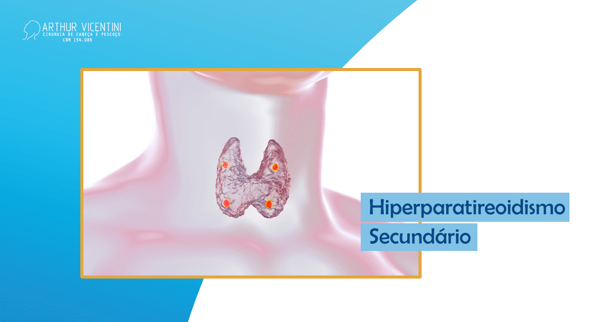 Hiperparatireoidismo Secundário - Dr. Arthur Vicentini CRM-SP 154086