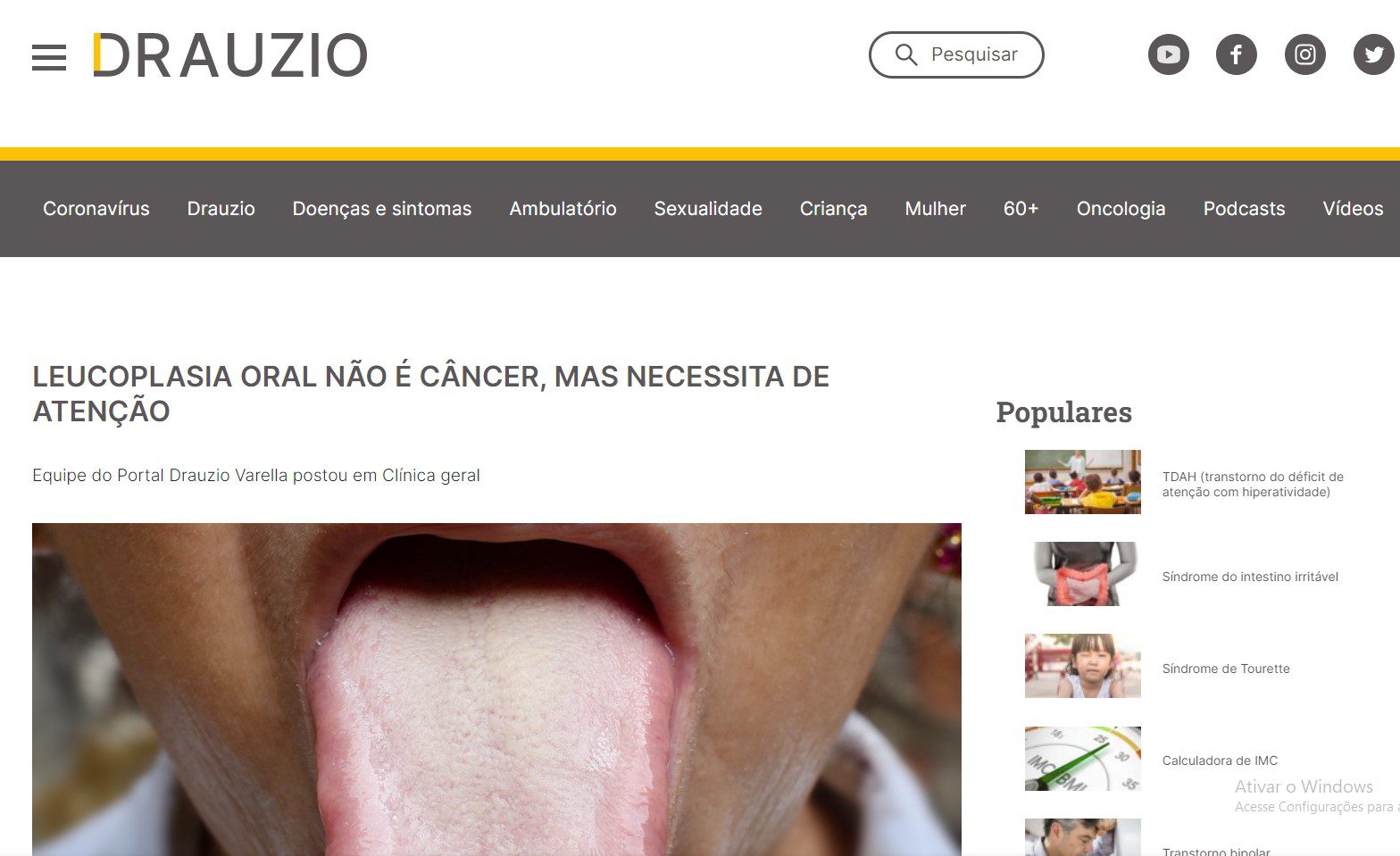 LEUCOPLASIA ORAL NÃO É CÂNCER, MAS NECESSITA DE ATENÇÃO Drauzio