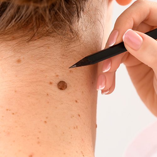 Pessoa aponta um lápis para uma pinta escura e elevada na nuca, sugerindo análise dermatológica ou exame de sinais na pele.